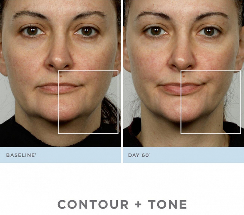 Аппарат для повышения тонуса кожи лица NuFACE TrinityPRO (Grey) купить в интернет-магазине icover
